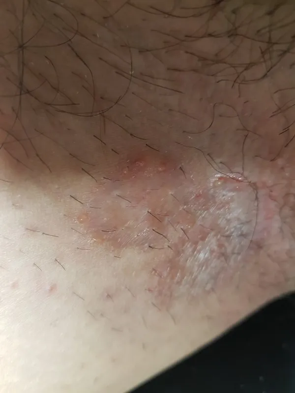 사타구니-습진-및-완선-가려움증