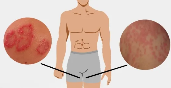 사타구니-습진-및-완선-가려움증