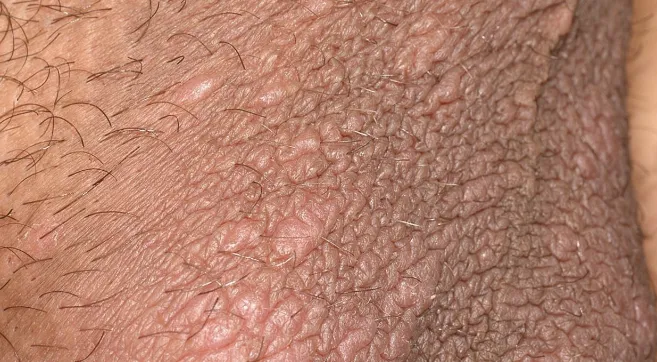 사타구니-습진-및-완선-가려움증