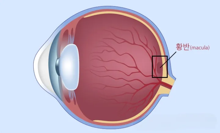 황반주름-초기증상