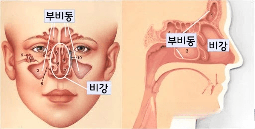 부비동암-부비동염-비강암