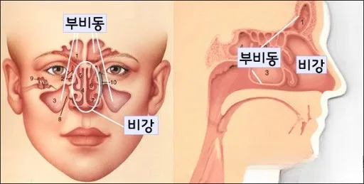 부비동암-부비동염-비강암
