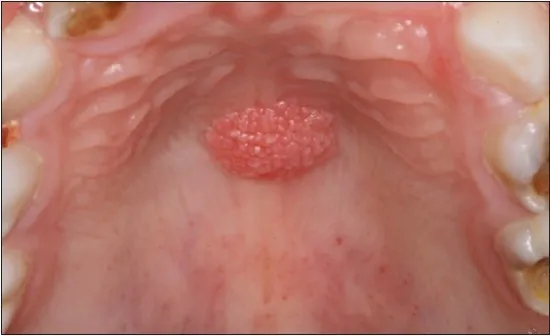 구강 유두종: 증상과 예방 방법 알아보기