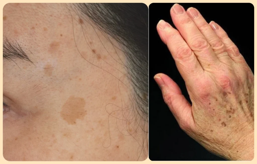 중년 피부 관리: 검버섯, 기미, 주근깨의 차이 2 중년-피부-관리:-검버섯