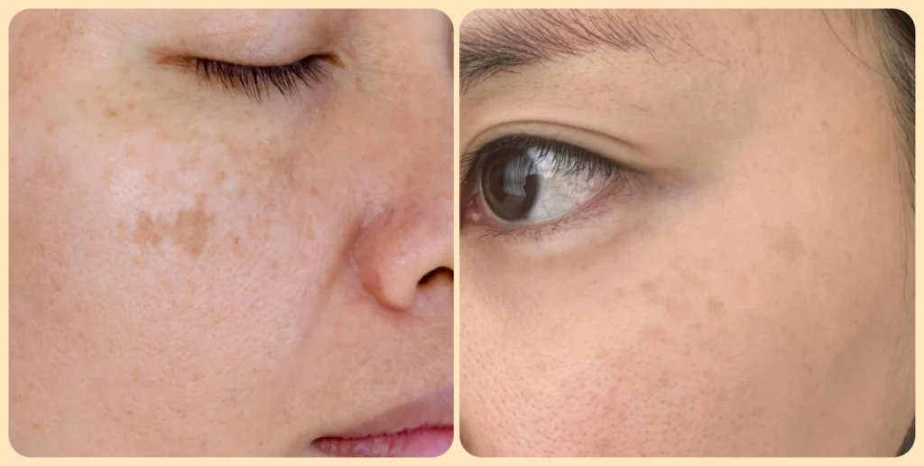 중년 피부 관리: 검버섯, 기미, 주근깨의 차이 3 중년-피부-관리:-기미