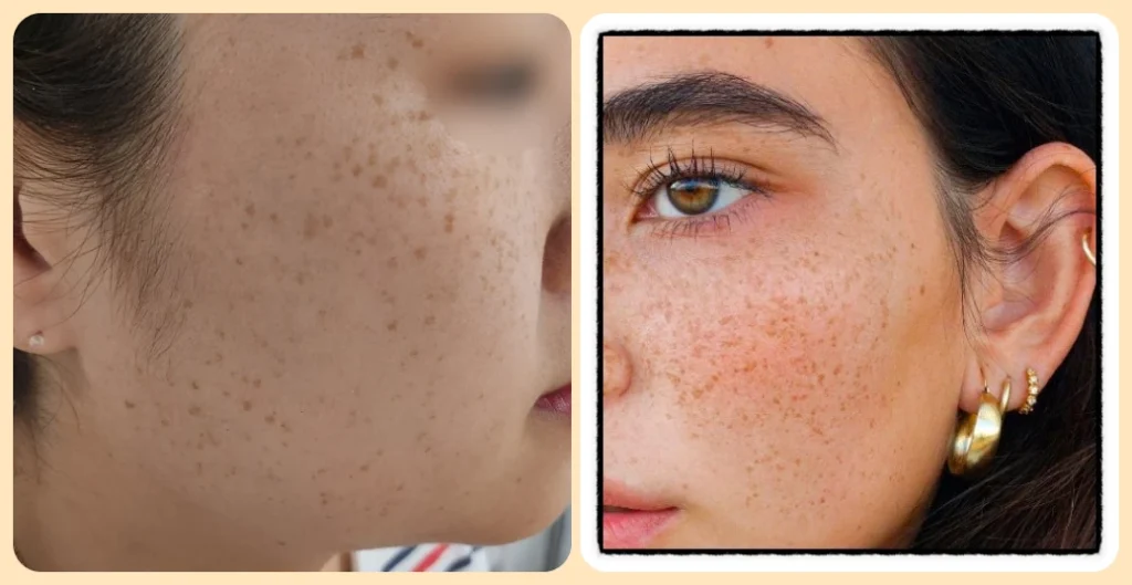 중년 피부 관리: 검버섯, 기미, 주근깨의 차이 4 중년-피부-관리:-주근깨